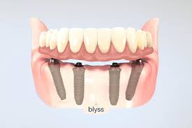 4 in one teeth implants