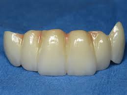 6 tooth bridge cost