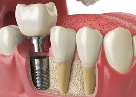 dental implant cost