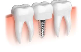 affordable dental implants