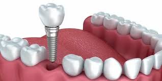 affordable dental implants cost