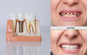 affordable teeth implants