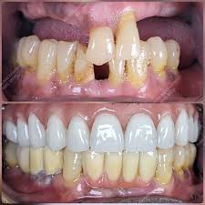 all on 4 dental implants cost