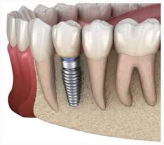 average cost of dental implants