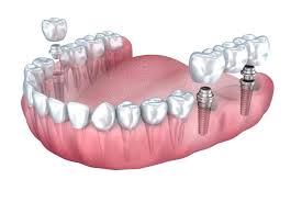 average price of dental implants