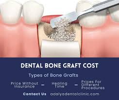 bone graft for dental implant cost