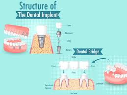 bridge for teeth cost