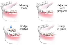 bridge in mouth cost