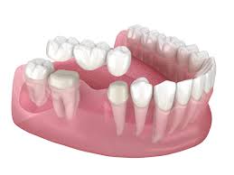 cheap dental implants
