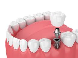 cheap implants
