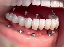 cheap teeth implants