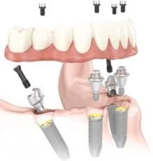 clear choice dental implants cost