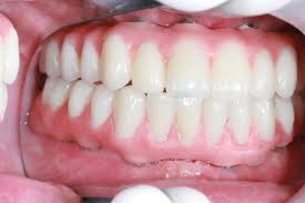 complete dental implants cost