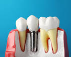cost for an implant tooth