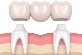 cost of a bridge for 3 teeth