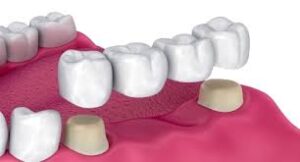 cost of a bridge for one tooth