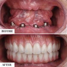 cost of a full mouth of dental implants