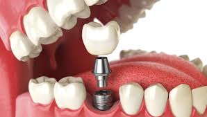 cost of one dental implant