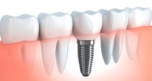 dental implant abroad