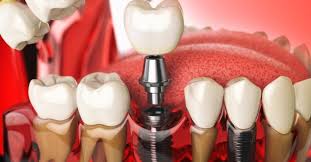 dental implant charges