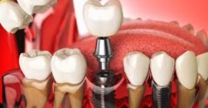 dental implant charges