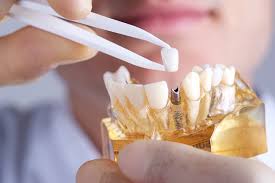 dental implant cost