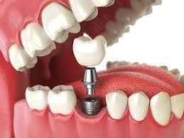 dental implant cost for one tooth