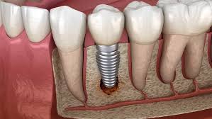 dental implant cost with insurance