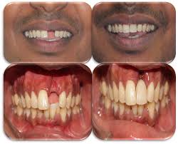 dental replacement cost