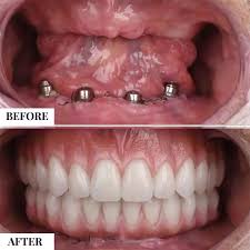 dental transplant cost
