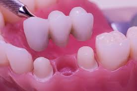 fix bridge teeth price
