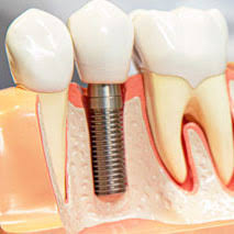 fixed tooth price