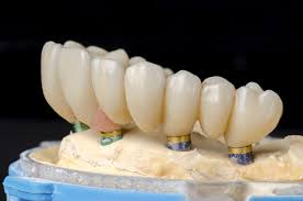 full arch dental implants cost