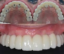 full dental implants cost
