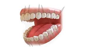 full mouth dental implants cost cheapest