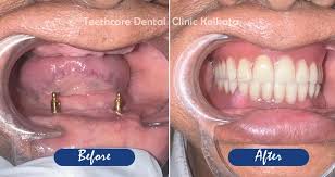 full mouth dental implants cost
