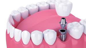 full set dental implants cost