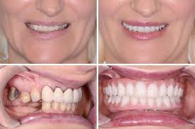 full set of dental implants