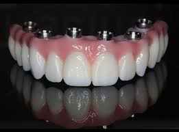 full set of teeth implants cost
