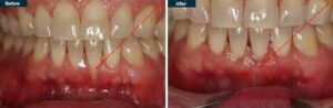 gum implant cost