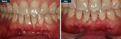 gum implant cost