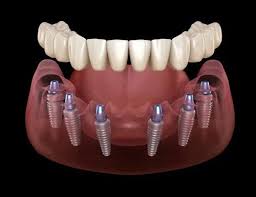 implant price