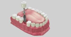 low cost dental implants