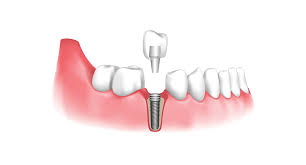 low price dental implants