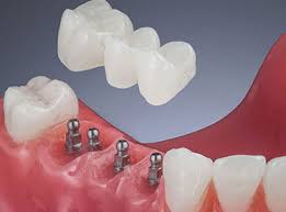 mini dental implants price
