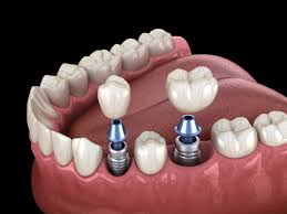 molar implant cost