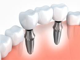 new teeth price