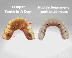 nuvia dental implant cost