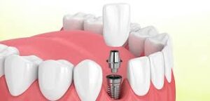 one teeth fixing cost