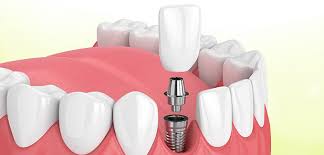one teeth fixing cost